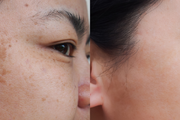 Closeup asian woman face before and after dark spot melasma pigmentation skin facial treatment.Problem skincare and health concept.